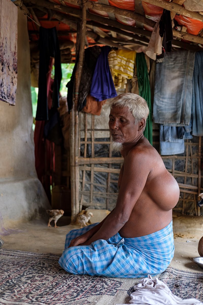 Jednašedesátiletý muž z Buthidaung s měkkotkáňovým nádorem na zádech a na krku. 20. září 2017 ©Antonio Faccilongo