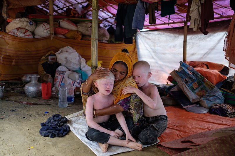 A mother comforts her two albino children in their tent, Unchiparang settlement. Sept 24, 2017 ©Antonio Faccilongo
