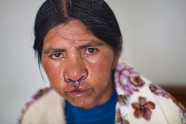 Post-surgery, Maltide's face was swollen and it was still painful to smile, but those routine issues soon disappear.