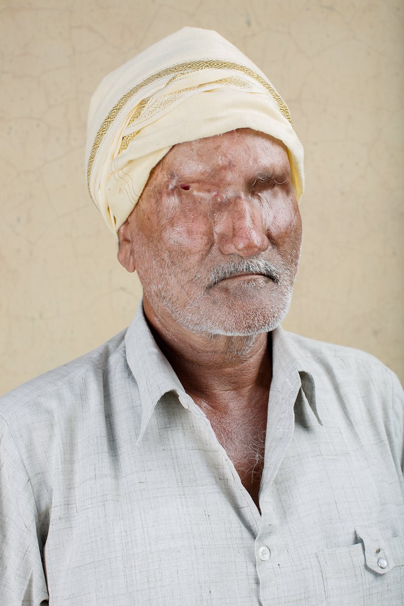 Portrait of Sankarlal looking towards the camera. His eyes are obscured by scar tissue from an acid attack.