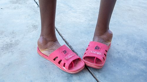 Plastic sandals provide temporary relief to kids that walk with severe clubfeet.