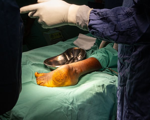 A clubfoot about to receive corrective surgery.