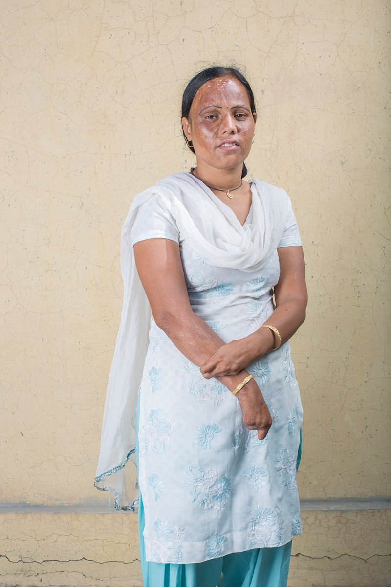 Portrait of Anuradha, showing the injuries to her face and hands from the fire she fell into as a child.