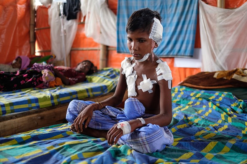 Zraněný rohingský chlapec sedí na posteli ve zdravotnickém zařízení Lékařů bez hranic v uprchlickém táboře Kutupalong v Cox´s Bazar.