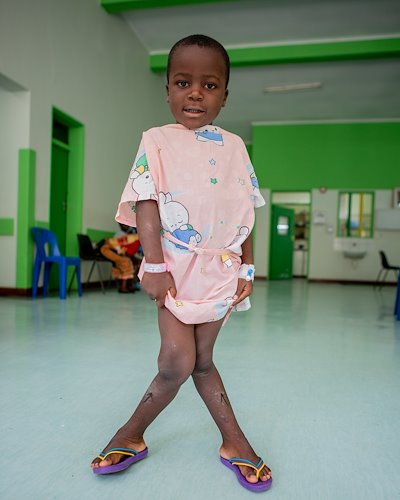 Before surgery to treat knock-knees