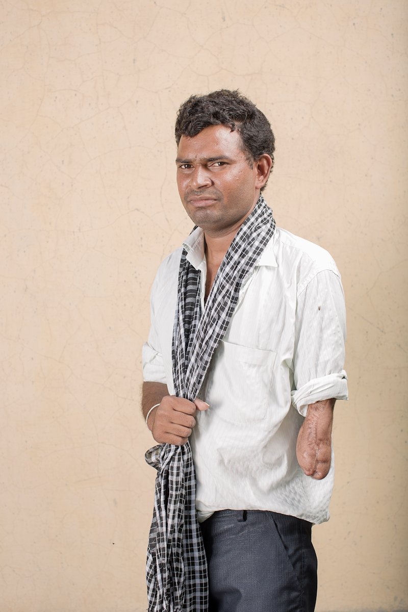 Portrait of Sohanlal. His left arm has been amputated below the elbow.