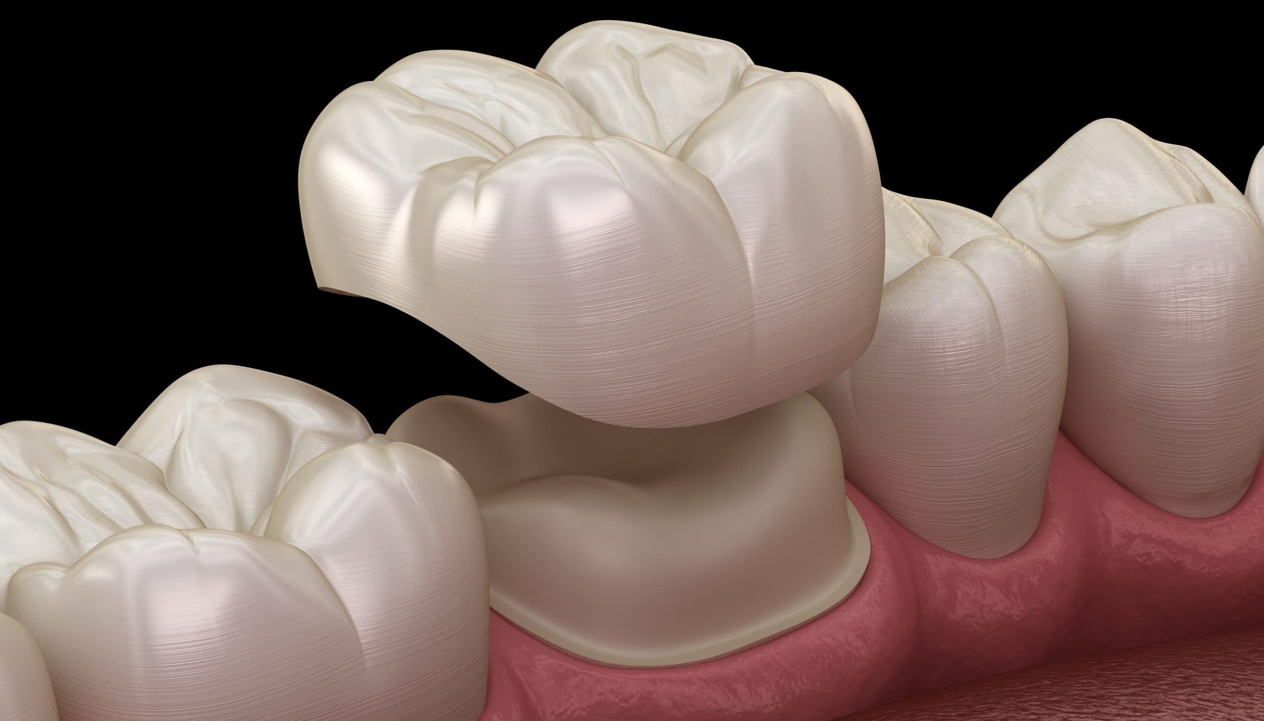 Read What Materials Are Used for Dental Crowns Generally? by Peter Astle